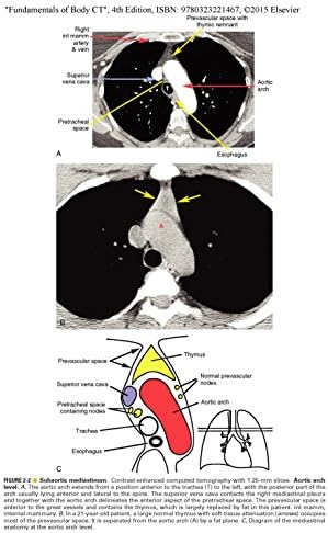 Fundamentals of Body CT (Fundamentals of Radiology) by W Richard Webb MD