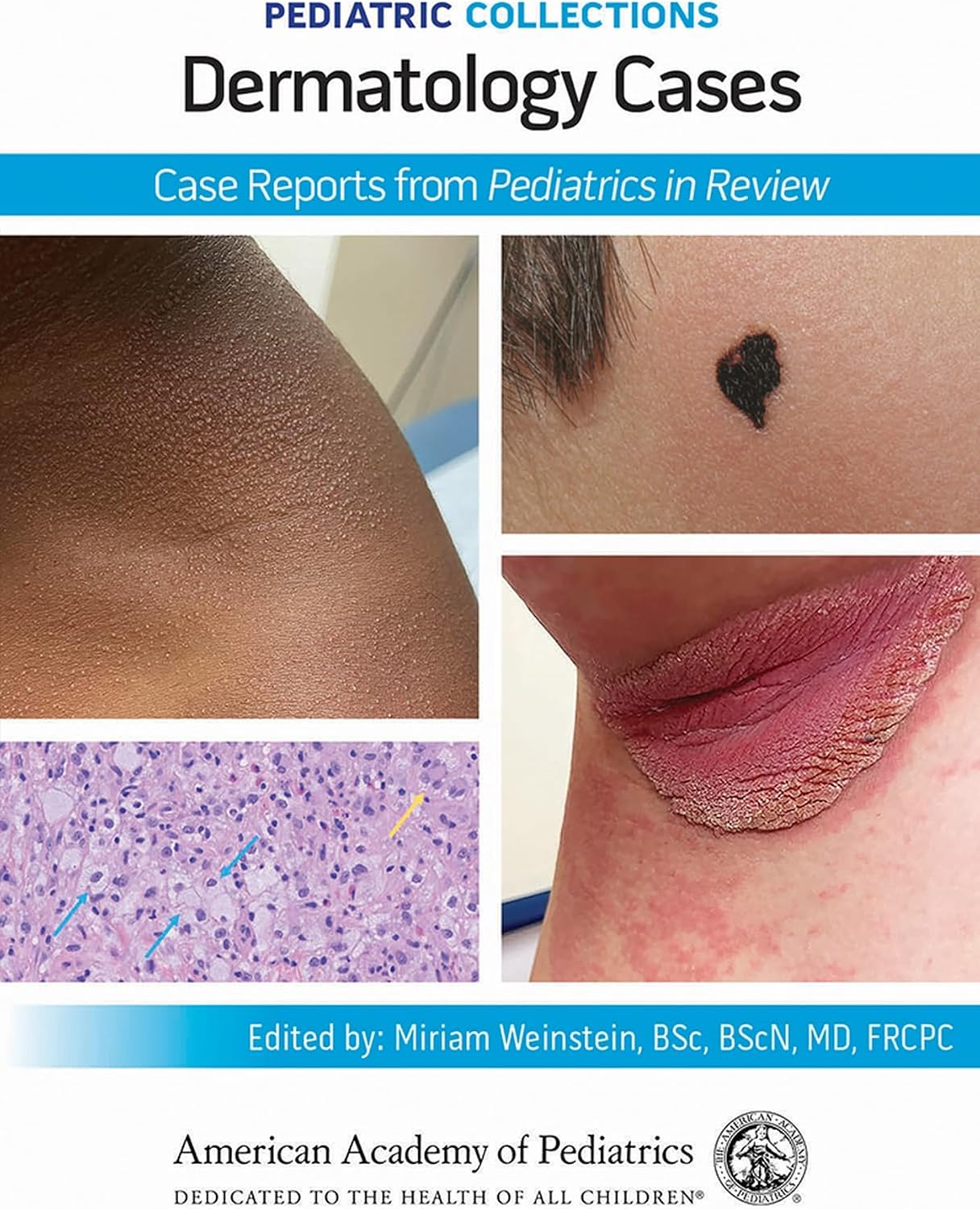 Pediatric Collections: Dermatology Cases: Case Reports from Pediatrics in Review by American Academy of Pediatrics (AAP)