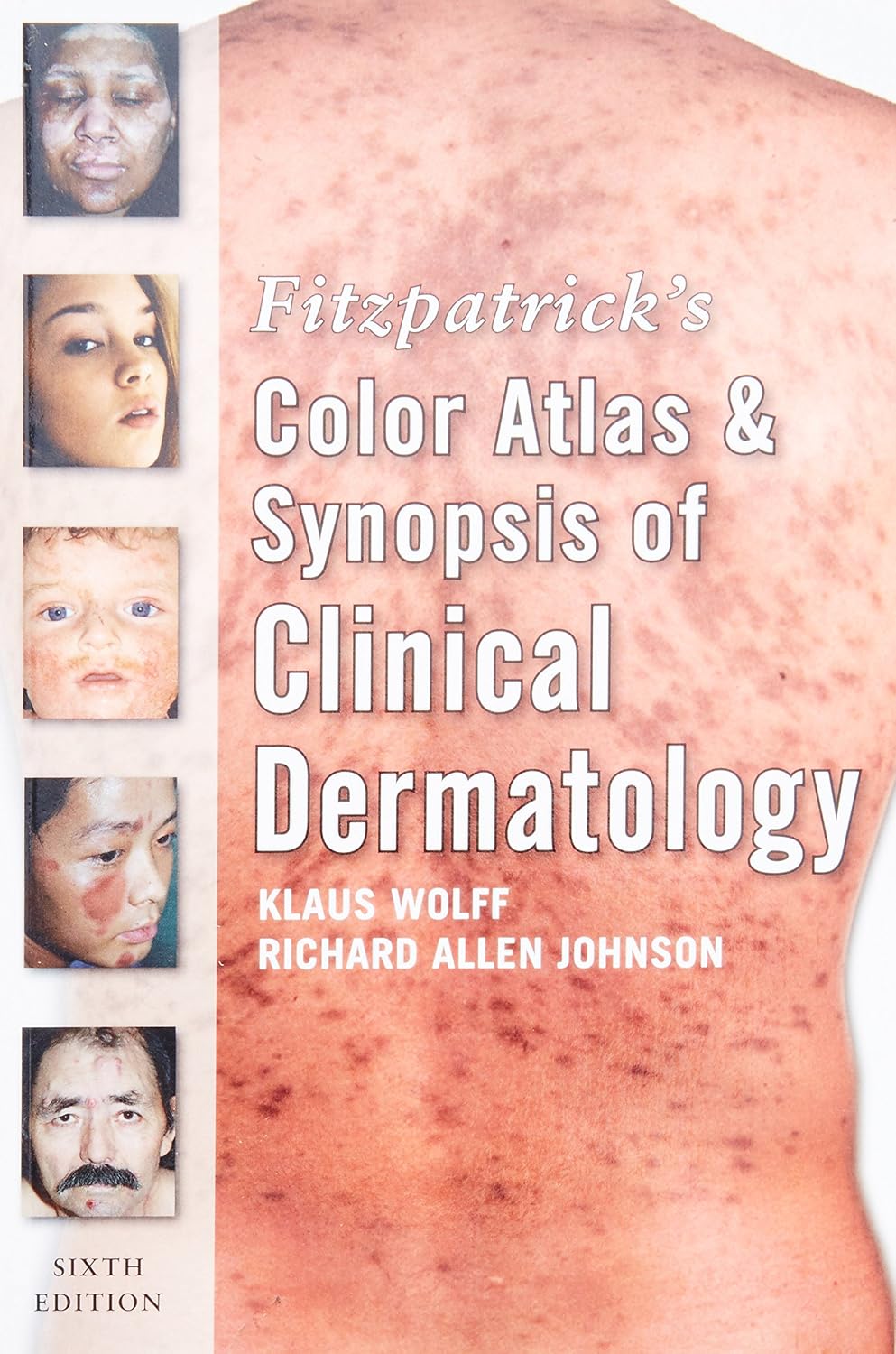Fitzpatrick's Color Atlas and Synopsis of Clinical Dermatology: Sixth Edition by Klaus Wolff